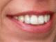 úsměv - zuby